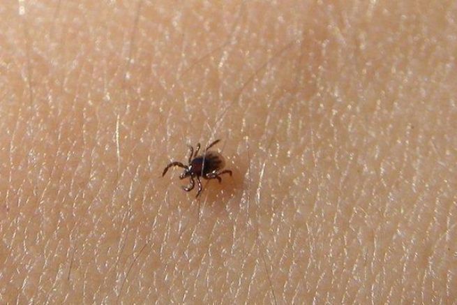 Anglerfreunde achten auf Zecken, kleine Insekten, die die Lyme-Krankheit übertragen Eine Zecke, die sich am Unterarm festgebissen hat