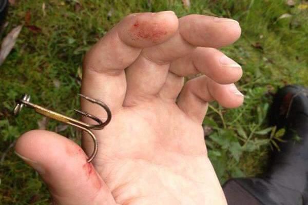 Wie entfernt man einen Angelhaken, der in die Hand gestochen wurde?